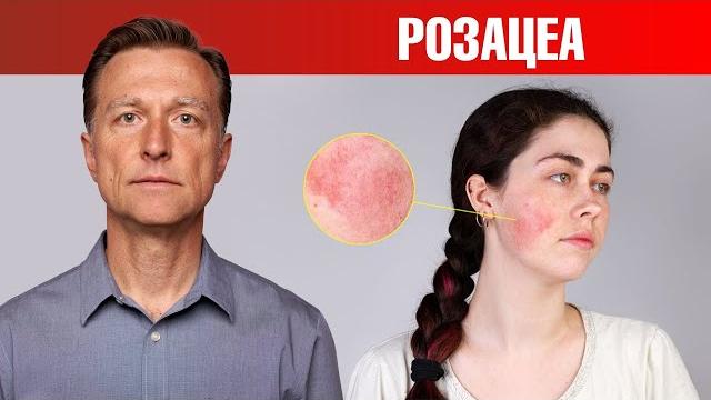 Если у вас розацеа, то ЭТО поможет. Если у вас розацеа, то ЭТО поможет.