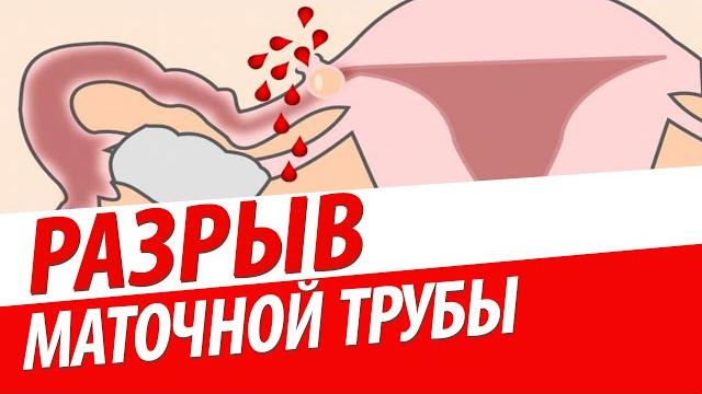 РАЗРЫВ МАТОЧНОЙ ТРУБЫ Гидросальпинкс / Пиосальпинкс / Трубная беременность. ЧТО ДЕЛАТЬ?! РАЗРЫВ МАТОЧНОЙ ТРУБЫ Гидросальпинкс / Пиосальпинкс / Трубная беременность. ЧТО ДЕЛАТЬ?!