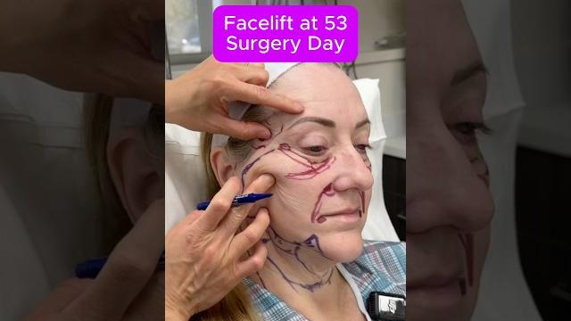 Facelift At 53 - Surgery Day (Interview) Facelift At 53 - Surgery Day (Interview)