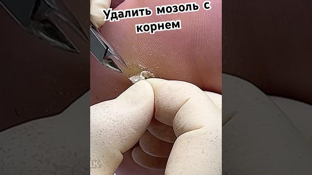 Целый процесс смотрите в разделе видео на моем канале #мозолька #мозоли #подологмосква Целый процесс смотрите в разделе видео на моем канале #мозолька #мозоли #подологмосква