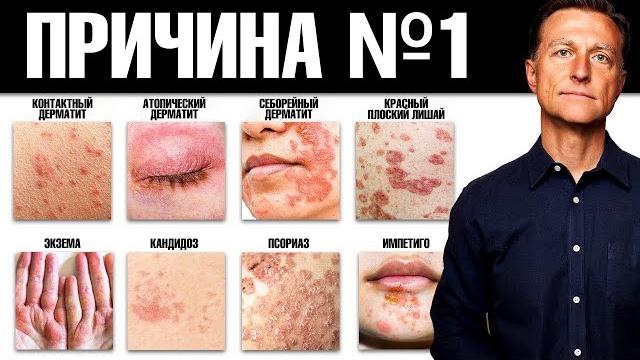При ВСЕХ кожных заболеваниях есть дефицит этого... При ВСЕХ кожных заболеваниях есть дефицит этого...