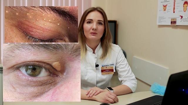 Удаление ксантелазм век Удаление ксантелазм век