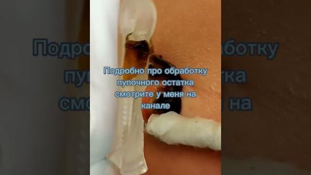 Обработка пупочного остатка Обработка пупочного остатка
