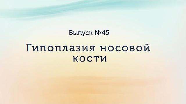 Гипоплазия носовой кости Гипоплазия носовой кости