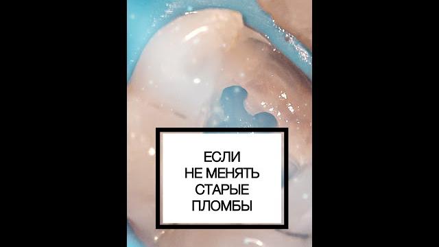 ЧТО МОЖЕТ БЫТЬ ПОД ПЛОМБОЙ? #shorts ЧТО МОЖЕТ БЫТЬ ПОД ПЛОМБОЙ? #shorts