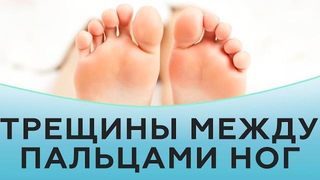 Трещины между пальцами ног Трещины между пальцами ног
