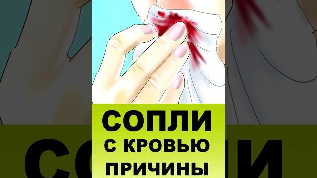 СОПЛИ С КРОВЬЮ. Выделения с прожилками крови СОПЛИ С КРОВЬЮ. Выделения с прожилками крови