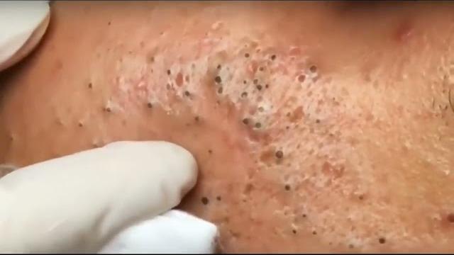 Чистка лица от угрей Чистка лица от угрей