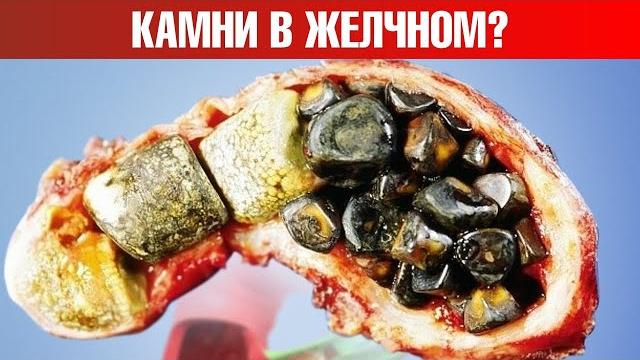 Первый симптом камней в желчном, который есть в 80% случаев Первый симптом камней в желчном, который есть в 80% случаев