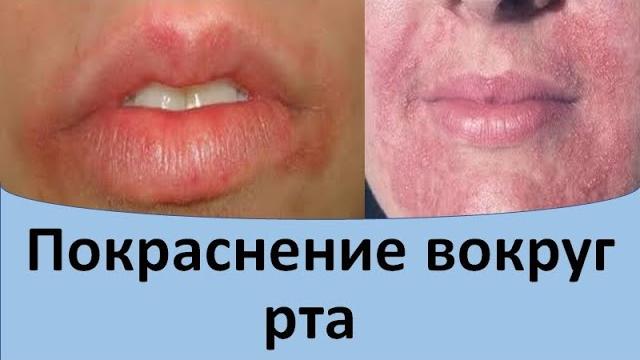 Покраснение вокруг рта. Покраснение вокруг рта.