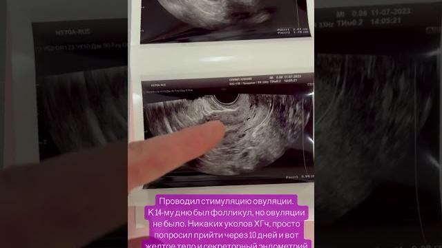 Овуляция на УЗИ Овуляция на УЗИ