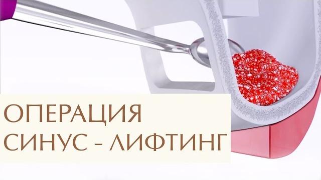 Способы наращивания костной ткани для имплантации. Наращивание костной ткани для имплантации. 12+ Способы наращивания костной ткани для имплантации. Наращивание костной ткани для имплантации. 12+