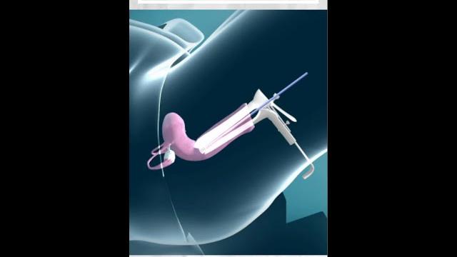 What is a pap smear? What is a pap smear?