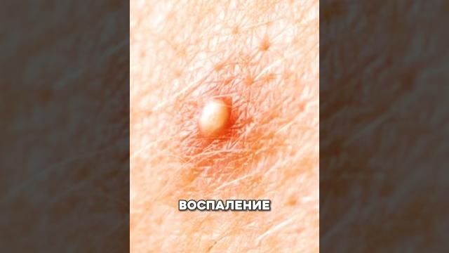 Решение твоих проблем тут️#акне #дерматолог #прыщи #лечениеакне #кожа #уход #угри #косметолог Решение твоих проблем тут️#акне #дерматолог #прыщи #лечениеакне #кожа #уход #угри #косметолог