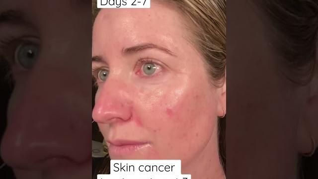 Days 2-7 of Fluorouracil treatment for skin cancer Days 2-7 of Fluorouracil treatment for skin cancer