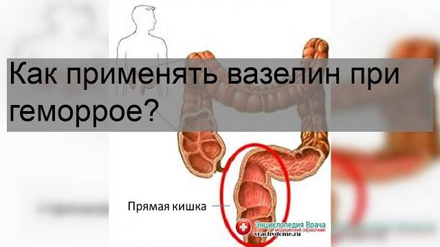 Как применять вазелин при геморрое? Как применять вазелин при геморрое?