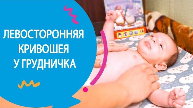 ЛЕВОСТОРОННЯЯ КРИВОШЕЯ У ГРУДНИЧКА 2 МЕСЯЦА ЛЕВОСТОРОННЯЯ КРИВОШЕЯ У ГРУДНИЧКА 2 МЕСЯЦА