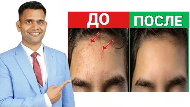 ПРЫЩИ НА ЛБУ? ЭТО ВАМ ПОМОЖЕТ! ПРЫЩИ НА ЛБУ? ЭТО ВАМ ПОМОЖЕТ!