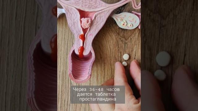 Медикаментозный аборт #врач #гинеколог #беременность Медикаментозный аборт #врач #гинеколог #беременность