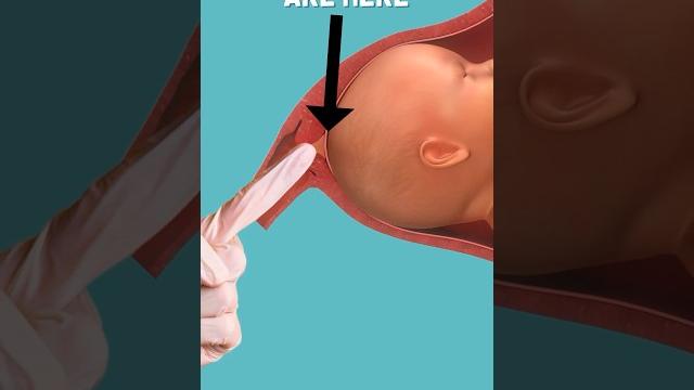 Membrane Sweep Procedure (stretch and sweep) #pregnancy #birth Membrane Sweep Procedure (stretch and sweep) #pregnancy #birth