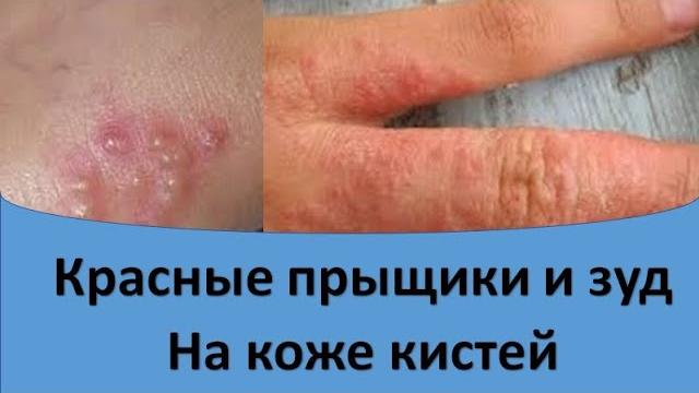 Красные прыщики и зуд на кистях Красные прыщики и зуд на кистях