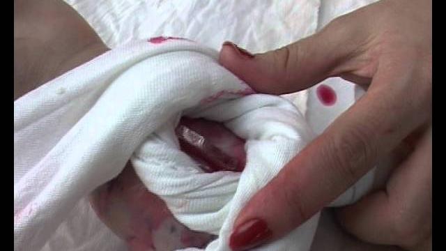 Помощь при кровотечении Помощь при кровотечении