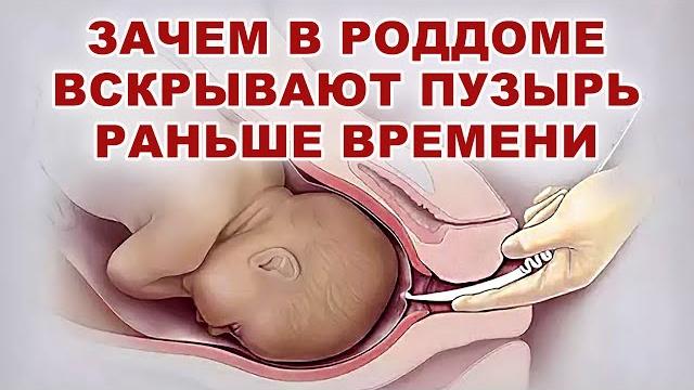 Когда вскрытие плодного пузыря опасно для родов? Зачем вскрывают плодный пузырь раньше времени? Когда вскрытие плодного пузыря опасно для родов? Зачем вскрывают плодный пузырь раньше времени?
