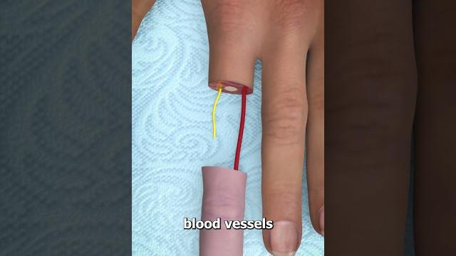 Can You Reattach a Severed Finger? Can You Reattach a Severed Finger?