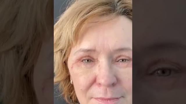 До и после верхней и нижней блефаропластики ( прошло всего 7 дней после операции) Есть отёки. До и после верхней и нижней блефаропластики ( прошло всего 7 дней после операции) Есть отёки.