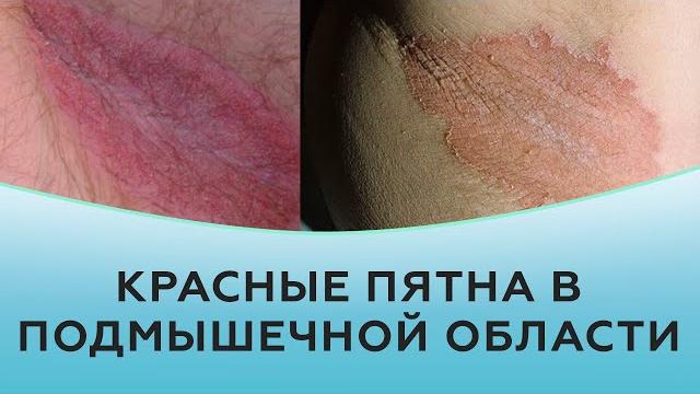 Красные пятна в подмышечной области Красные пятна в подмышечной области