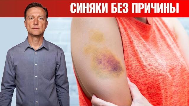Почему появляются гематомы? Синяки на теле без причины️ Почему появляются гематомы? Синяки на теле без причины️