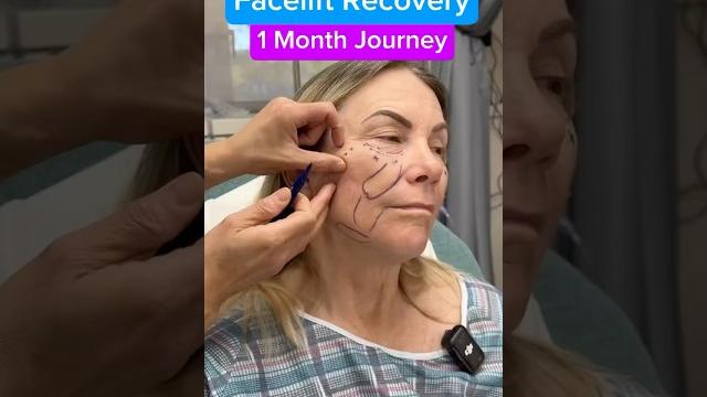 AMAZING Natural Facelift Transformation!! (Journey) AMAZING Natural Facelift Transformation!! (Journey)
