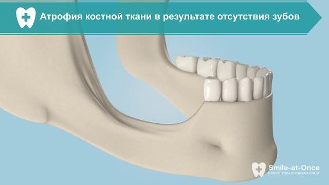 Наращивание костной ткани костными блоками Наращивание костной ткани костными блоками