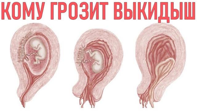 УГРОЗА ВЫКИДЫША | Почему происходит выкидыш УГРОЗА ВЫКИДЫША | Почему происходит выкидыш