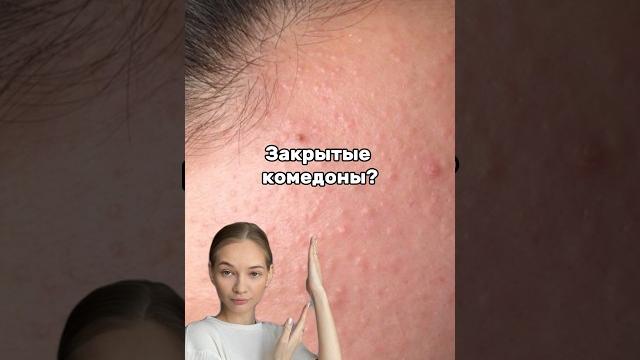 НЕ МОЖЕШЬ ИЗБАВИТЬСЯ от ПРЫЩЕЙ? Черных точек и КОМЕДОНОВ? Попробуй эту сыворотку Wb:142054898 НЕ МОЖЕШЬ ИЗБАВИТЬСЯ от ПРЫЩЕЙ? Черных точек и КОМЕДОНОВ? Попробуй эту сыворотку Wb:142054898