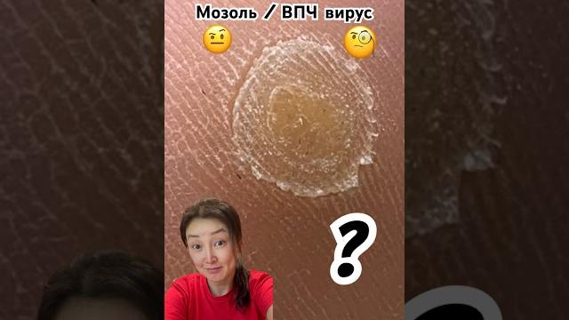 Что это ? #подолог #бородавки #мозоли Что это ? #подолог #бородавки #мозоли