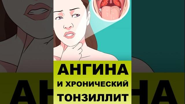 АНГИНА И ХРОНИЧЕСКИЙ ТОНЗИЛЛИТ АНГИНА И ХРОНИЧЕСКИЙ ТОНЗИЛЛИТ