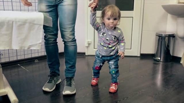 Дисплазия тазобедренных суставов у детей. Лечение по методу Игнатьева.Последствия аппарата и шины. Дисплазия тазобедренных суставов у детей. Лечение по методу Игнатьева.Последствия аппарата и шины.