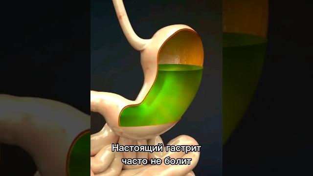 Что лечить? Гастрит и Функциональная диспепсия Что лечить? Гастрит и Функциональная диспепсия
