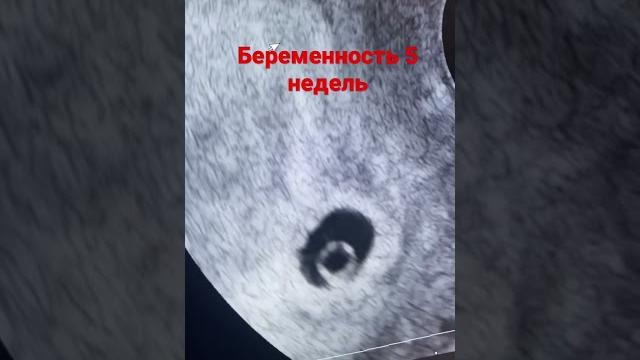 Беременность 5 недель Беременность 5 недель