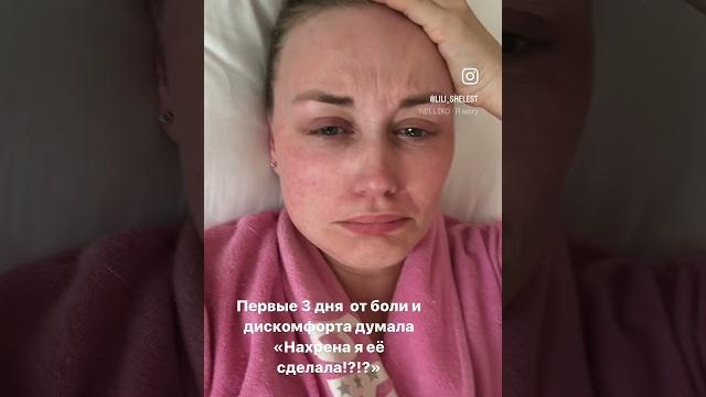 #абдоминопластика #липосакция #абдоминопластика #липосакция