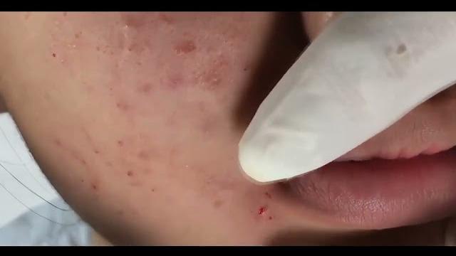 Аккуратная чистка лица. Давим прыщи - черные точки, acne blackheads. Видео с прыщами 2021 Аккуратная чистка лица. Давим прыщи - черные точки, acne blackheads. Видео с прыщами 2021