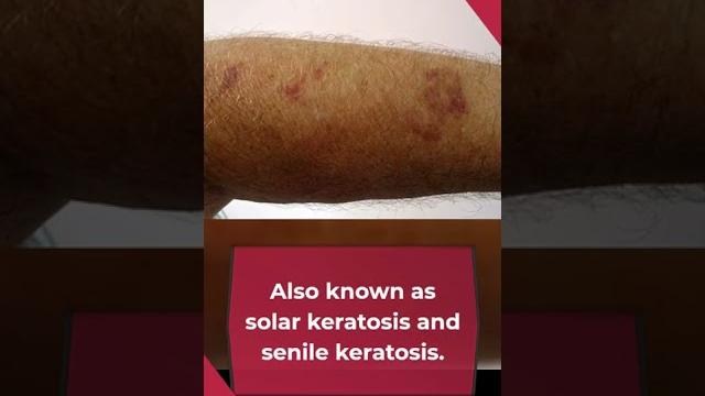Actinic keratosis Actinic keratosis