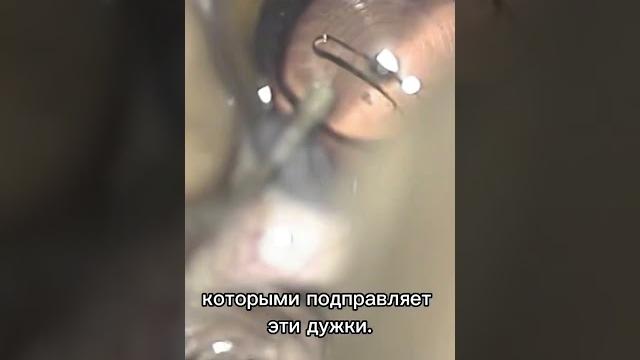 Удаление катаракты. Часть 11. Имплантация искусственного хрусталика / Катаракта от А до Я Удаление катаракты. Часть 11. Имплантация искусственного хрусталика / Катаракта от А до Я