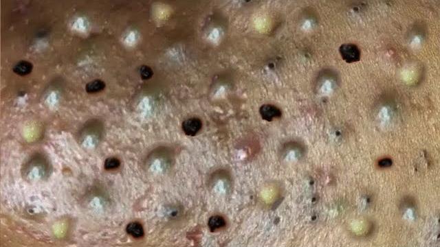 Самое залипательное видео давить прыщи Dermatologist.video to press pimples Черные точки #010 | Acne Самое залипательное видео давить прыщи Dermatologist.video to press pimples Черные точки #010 | Acne