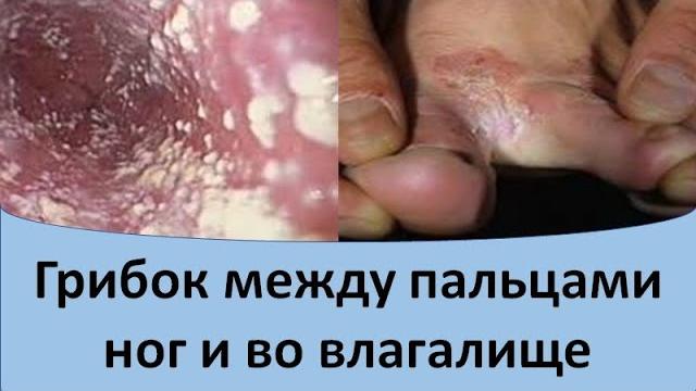 Грибок между пальцами ног и во влагалище Грибок между пальцами ног и во влагалище