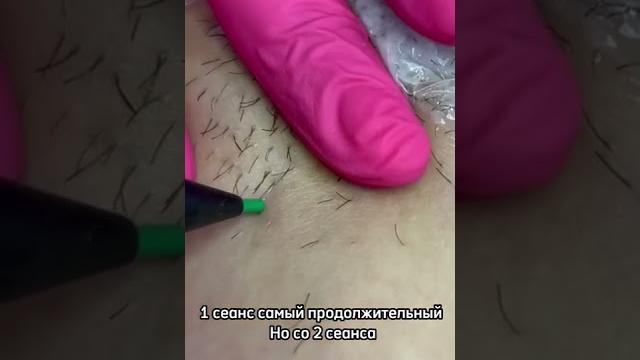 Хотим развеять миф о том что электроэпиляция это больно Хотим развеять миф о том что электроэпиляция это больно