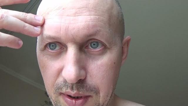 ШЕЛУШИТСЯ КОЖА НА ЛИЦЕ ДЕФИЦИТ ОМЕГА 3 НЕХВАТАЕТ МОНОНЕНАСЫЩЕНЫХ И ПОЛИНЕНАСЫЩЕННЫЙ ЖИРОВ ШЕЛУШИТСЯ КОЖА НА ЛИЦЕ ДЕФИЦИТ ОМЕГА 3 НЕХВАТАЕТ МОНОНЕНАСЫЩЕНЫХ И ПОЛИНЕНАСЫЩЕННЫЙ ЖИРОВ
