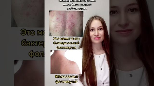 Прыщи на спине Прыщи на спине