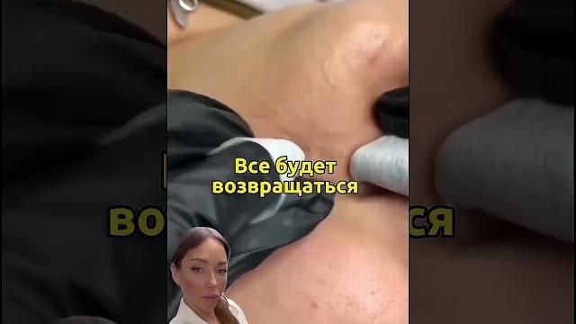 Как убрать закрытые комедоны? 2 способа #акне Как убрать закрытые комедоны? 2 способа #акне